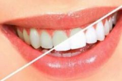 5类人不能做牙齿整形手术说明