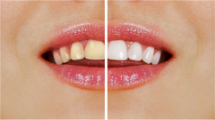 牙齿美白哪种方法好对牙没有伤害